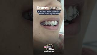 Braces Transformation in just 1 month Watch now braces teeth teethbraces [upl. by Minier]