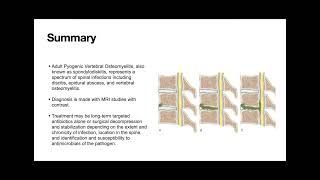 52022 Spinal Infection Osteomyelitis Discitis Epidural Abscess Lead by Dr Lamping [upl. by Alehc186]