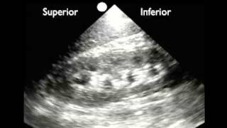 How To Renal Ultrasound  Hydronephrosis Case Study Video [upl. by Aniroz]