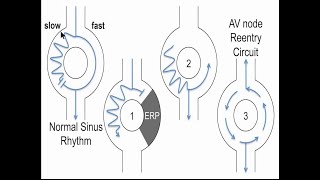 ECG part 2 SVT Atrioventricular Nodal Reentry Tachycardia AVNRT [upl. by Gnuhc15]