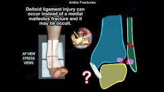 Ankle Fractures  Everything You Need To Know  Dr Nabil Ebraheim [upl. by Rochelle]