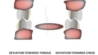 Introduction to equilibration Occlusal interferences [upl. by Nikos]