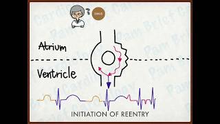 Reentry tachycardia mechanism [upl. by Kcinimod197]