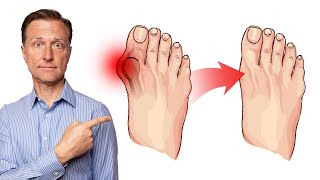 How to Fix Bunions in 3 Steps [upl. by Sara]