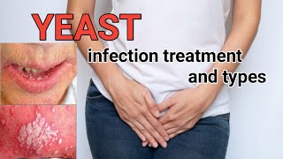 Yeast fungal Infection Types And Treatment  What Is Yeast Infection [upl. by Bucher]