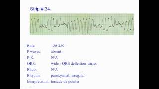 ECG Exercise 34 [upl. by Travax]