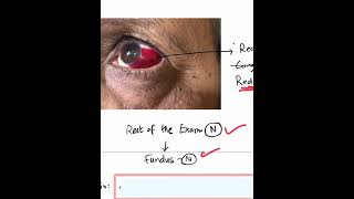 SubConjunctival Hemorrhage SCH  Case Discussion In A Minute Shorts [upl. by Seidnac301]