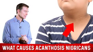 What Causes Acanthosis Nigricans Darkened Skin Folds – Dr Berg [upl. by Cos362]