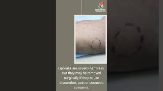 Lipoma removal  Cutis Hospital Bangalore  Skin Surgery Skincare [upl. by Nirual]