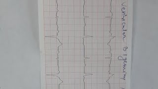 ventricular bigeminy and trigeminy [upl. by Leong]