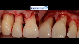 Periodontal Surgery with Regeneration for Upper Teeth [upl. by Lamprey]