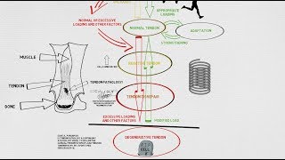 Tendinopathy Continuum and Update [upl. by Aronas]