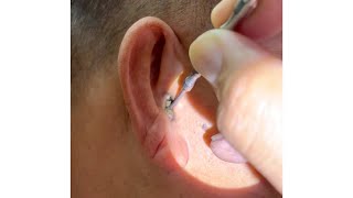 Removing Grandpas 70 Year Old Hard Earwax [upl. by Wirth236]