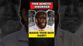 Did you know Unraveling Hypertrichosis Excessive Hair Growth Called as werewolf syndrome [upl. by Ayad]