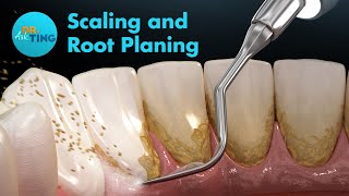 What Happens During a Deep Cleaning Procedure Scaling and Root Planing [upl. by Levison]