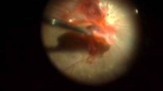 Hemorrhagic Neovascular Frond Removal [upl. by Falzetta]