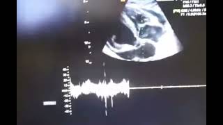 Echo cardiography of cardiac tamponade [upl. by Onaireves651]