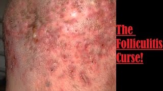 The Folliculitis Curse [upl. by Eicats]