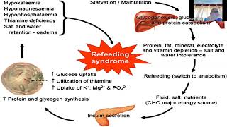 Refeeding Syndrome RFS Prof R K Singh Emergency Medicine SGPGI [upl. by Nonnel]