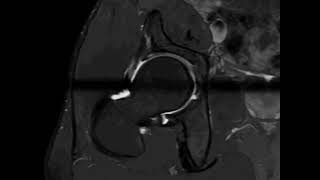 Mri hip arthrography radial sequence [upl. by Pansir568]