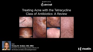 Treating Acne with the Tetracycline Class of Antibiotics A Review [upl. by Seidule]