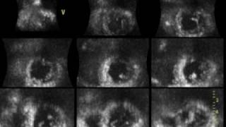 ACUTE MYOCARDIAL INFARCTION ANTEROSEPTAL 3D ECHOCARDIOGRAPHY cardiac ultrasound [upl. by Berner]