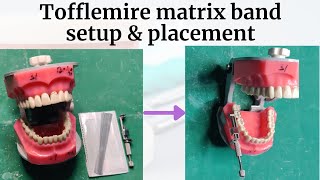 Tofflemire Retainer Parts Matrix Band setup and placement  Universal Matrix  Matricing [upl. by Brout]