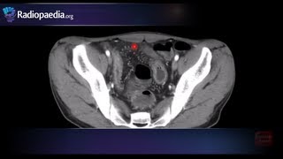 Cases in Radiology Episode 4 musculoskeletal MRI xray [upl. by Anehsat]