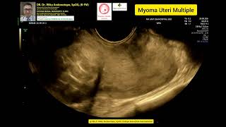 Myoma Uteri Multiple [upl. by Ael969]