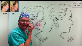 SMAS vs Deep Plane Facelift What You Need to Know  Philadelphia Facelift Surgeon Dr Claytor [upl. by Liane]