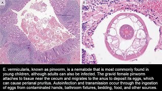 Enterobius vermicularis Madenwurm im Appendix [upl. by Kopp]