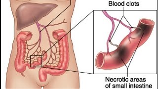 Mesenteric Ischemia [upl. by Otilegna]