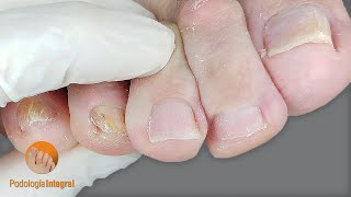 Fallen metatarsus  plantar corns and calluses  Affected skin and toenails  Comprehensive Podology [upl. by Primaveras]