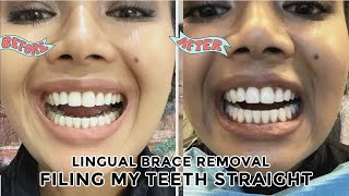 Filing roundchipped teeth straight enameloplasty amp inbrace lingual braces removal day [upl. by Gnaht]