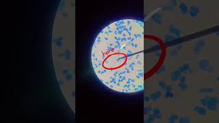 Mycobacterium tuberculosis in acid fast bacilli 🦠 [upl. by Aelahs]