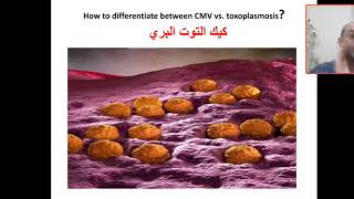 How to differentiate between CMV vs Toxoplasmosis Congenital infection periventricular calcificat [upl. by Marcille]