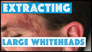 Acne Vulgaris and Extracting large Whiteheads  Part 1 [upl. by Amat]