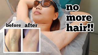 WHAT IS IPL HAIR REMOVAL MY IPL JOURNEY [upl. by Letsyrc776]