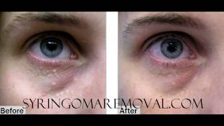 Syringoma Removal using TCA in cosmetic Clinics [upl. by Zitvaa]