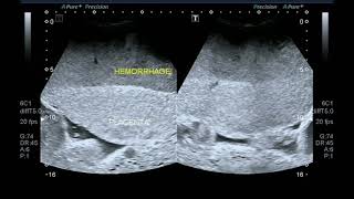 Ultrasound video showing retroplacental hemorrhageplacental abruption [upl. by Vacuva728]