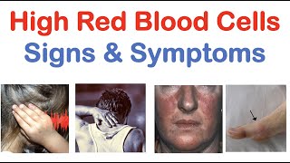 High Red Blood Cells Polycythemia Signs amp Symptoms amp Why They Occur [upl. by Nitsirhc]