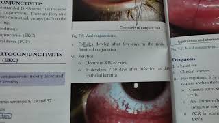 epidemic keratoconjunctivitis opthamology [upl. by Meeks171]