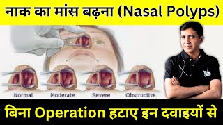 Nasal Polyps  नाक का मांस बढ़ने के लक्षण कारण व इलाज [upl. by Abell]