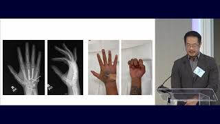 15 Metacarpal and Phalangeal Fractures Nicolas Lee MD 020 [upl. by Nnylyar]