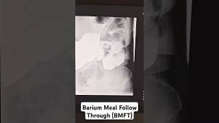 Barium Meal Follow Through BMFT barium xray radiology hospital students study [upl. by Guss]