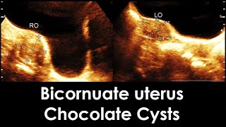 Practical ultrasound case of Bicornuate uterus  Endometriosis  Chocolate Cysts  Nabothian cyst [upl. by Hey736]