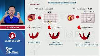 CARDIOLOGÍA Cardiopatía isquémica Angina inestable SICA mp4 [upl. by Rasla357]