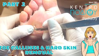 Toe Calluses amp Hard Skin Removal 1Αφαίρεση επιδακτύλιων κάλων amp σκληρύνσεωνΚέντρο Ποδιού Podiatry [upl. by Entroc271]