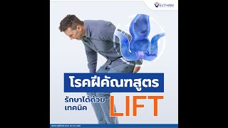 รักษาโรคฝีคัณฑสูตร ด้วยเทคนิค LIFT subtitle I โรงพยาบาลเวชธานี [upl. by Ardnohs]