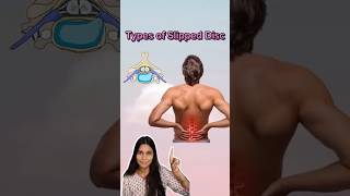 Types of slipped disc physiotherapy medicolife ytshorts physiotopics [upl. by Eirot]